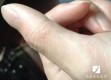 揭秘夏日手部小水疱，成因、真相与有效应对策略